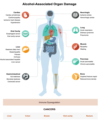 Alcohol-associated organ damage